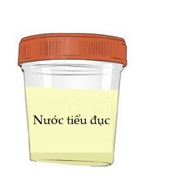 Nước tiểu đục- Dấu hiệu viêm đường tiết niệu ở bà bầu 